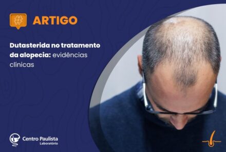 Dutasterida no tratamento da alopecia: evidências clínicas