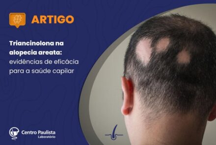 Triancinolona na alopecia areata: evidências de eficácia para a saúde capilar