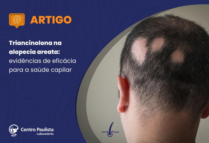Triancinolona na alopecia areata: evidências de eficácia para a saúde capilar